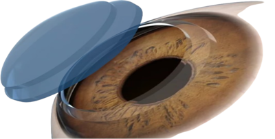 Cornea surgery